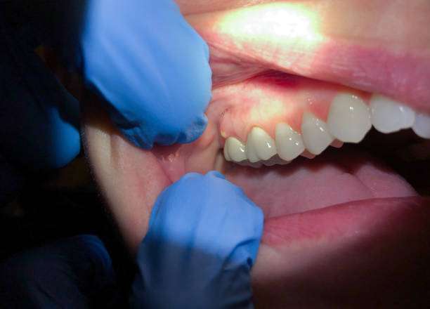 Best Emergency Care for Gum Disease in Oakton, VA